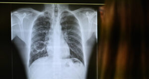 Els ingressos per tuberculosi creixen lleument cada any a l’Hospital Joan XXIII